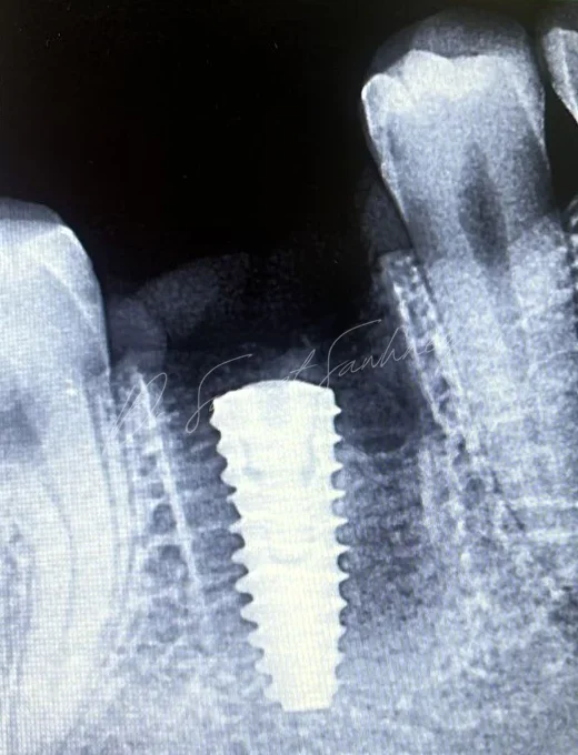 Post-placement periapical radiograph showing a single posterior mandibular dental implant